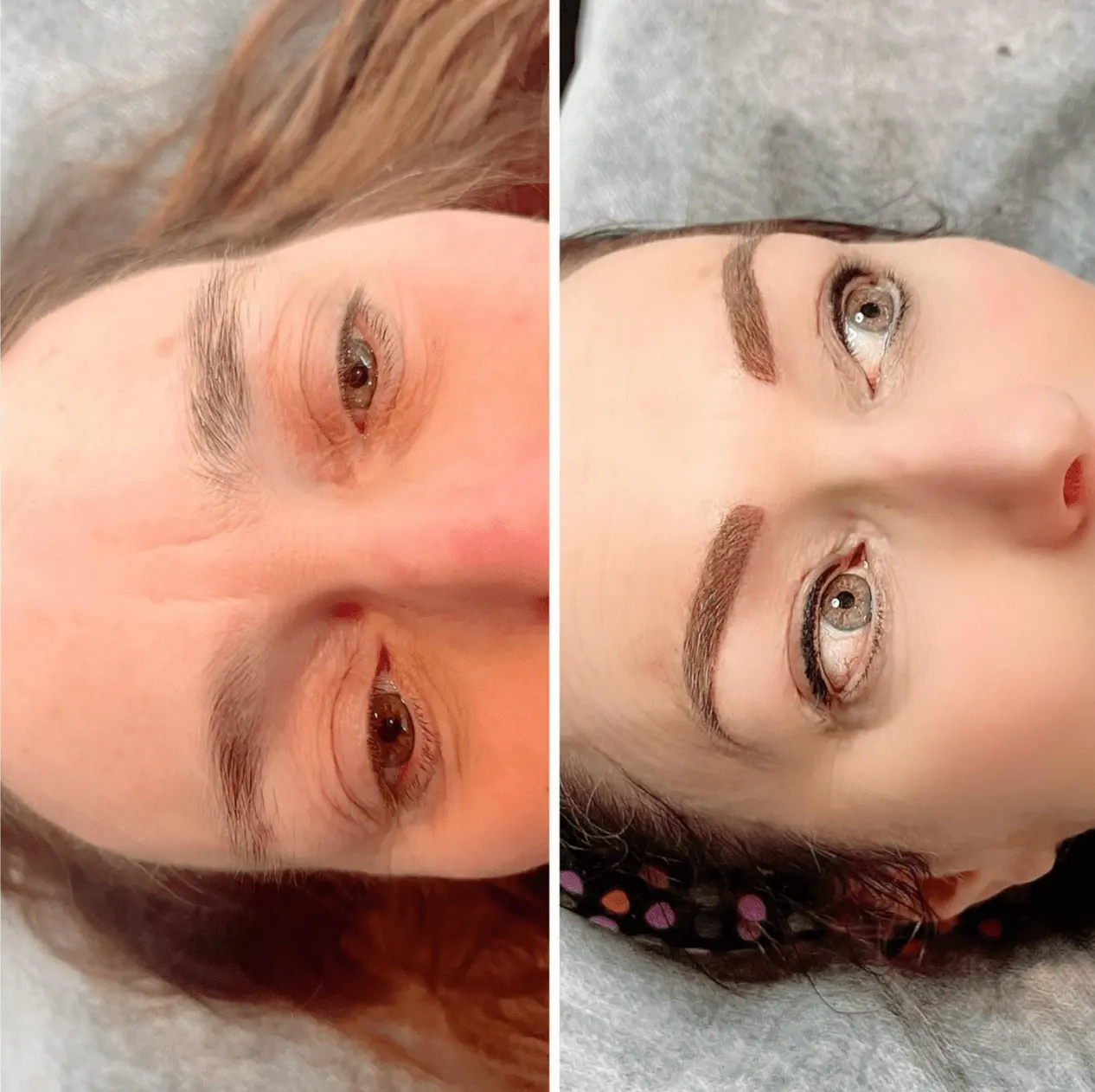 Saline Tattoo Removal Before And After