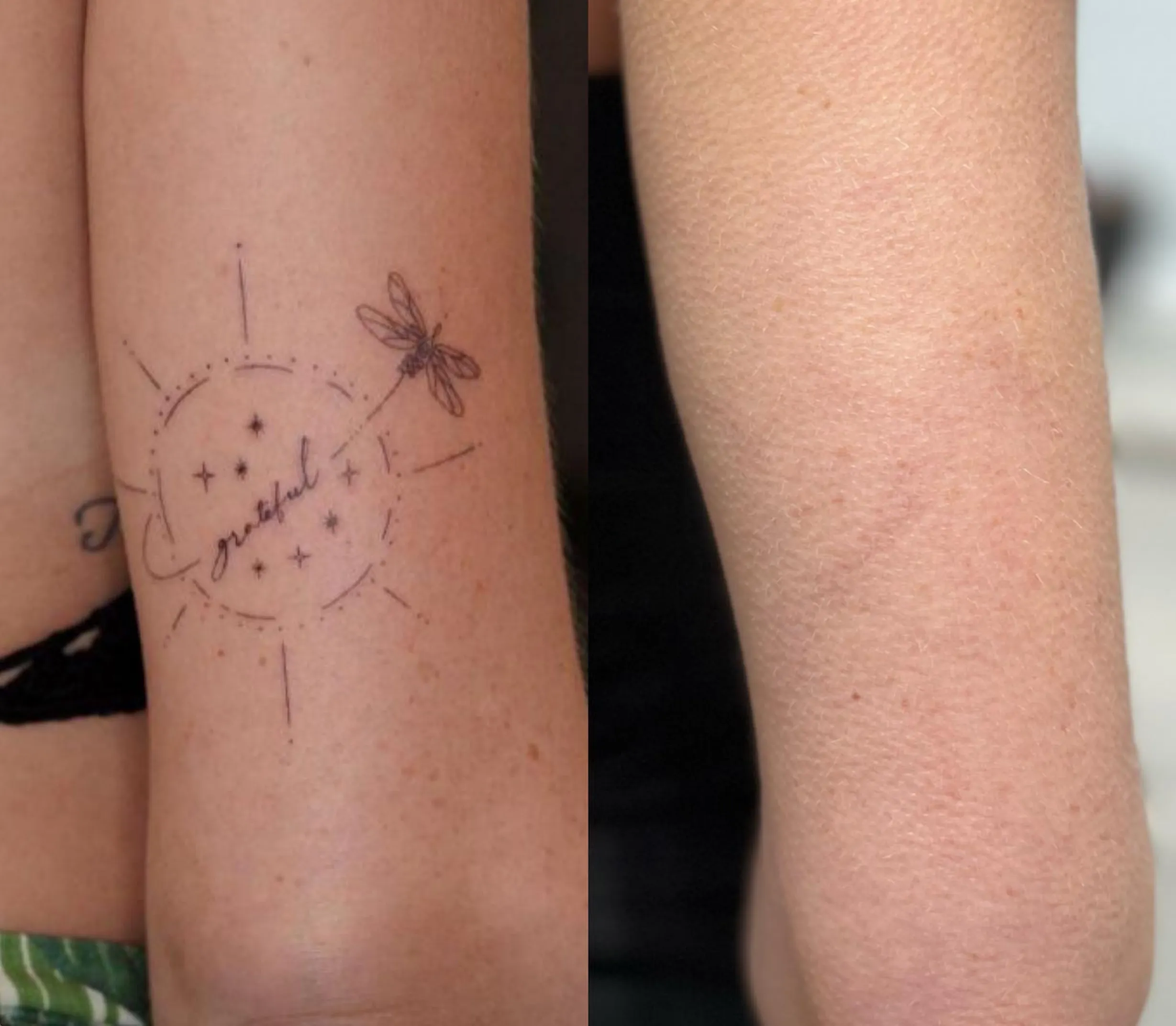 eyebrow tattoo fading vs removal