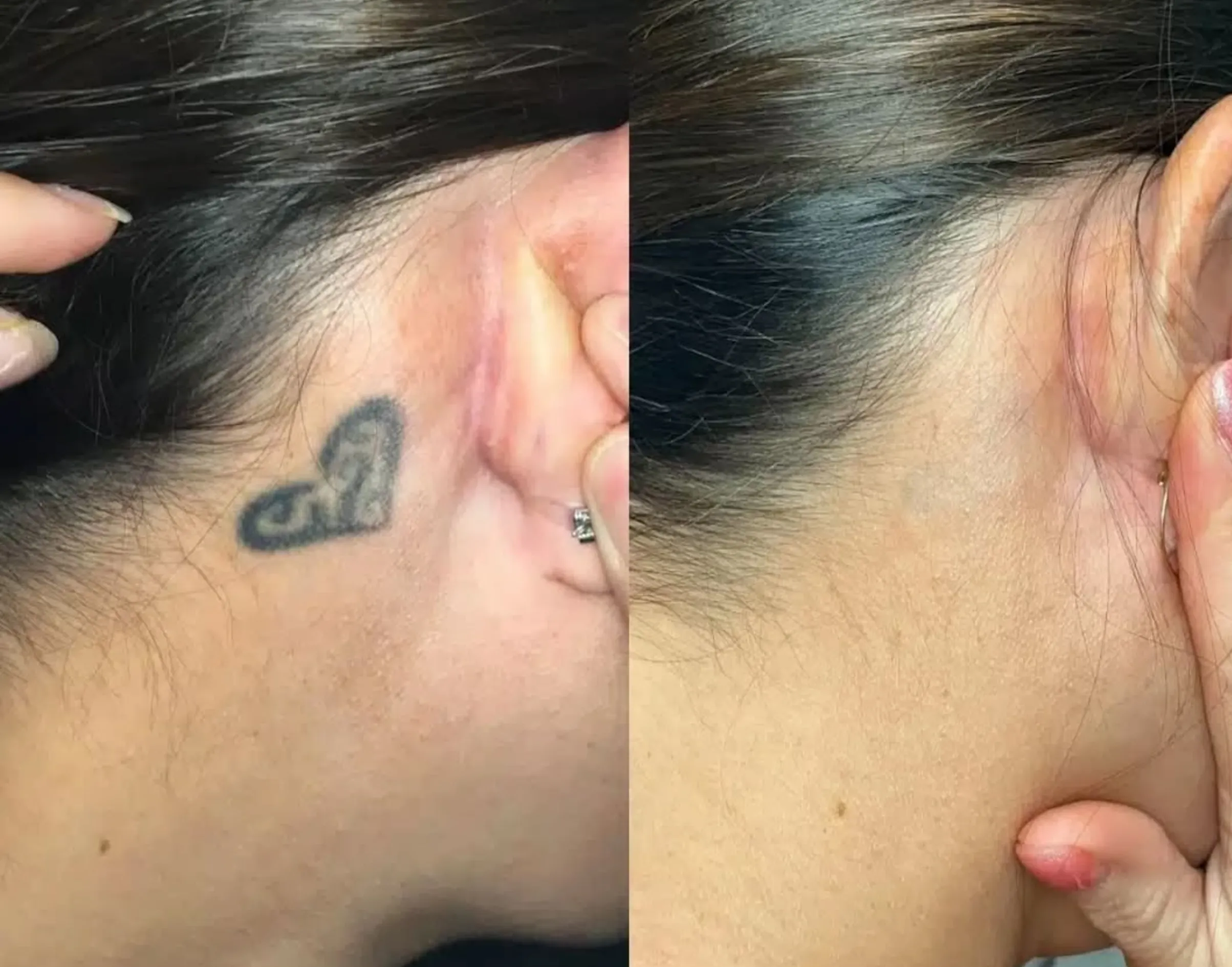 cosmetic tattoo removal success