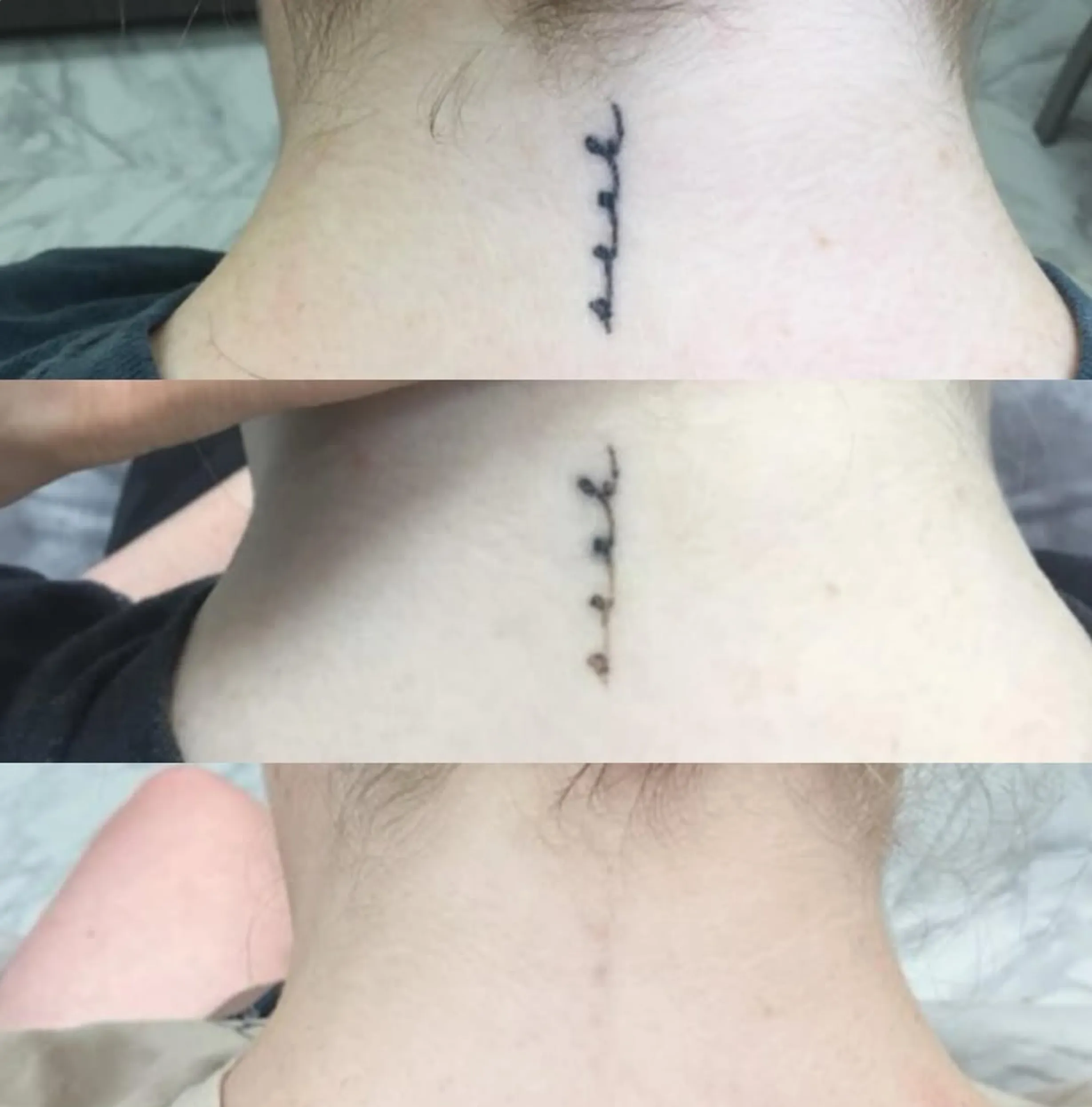 laser tattoo removal effectiveness