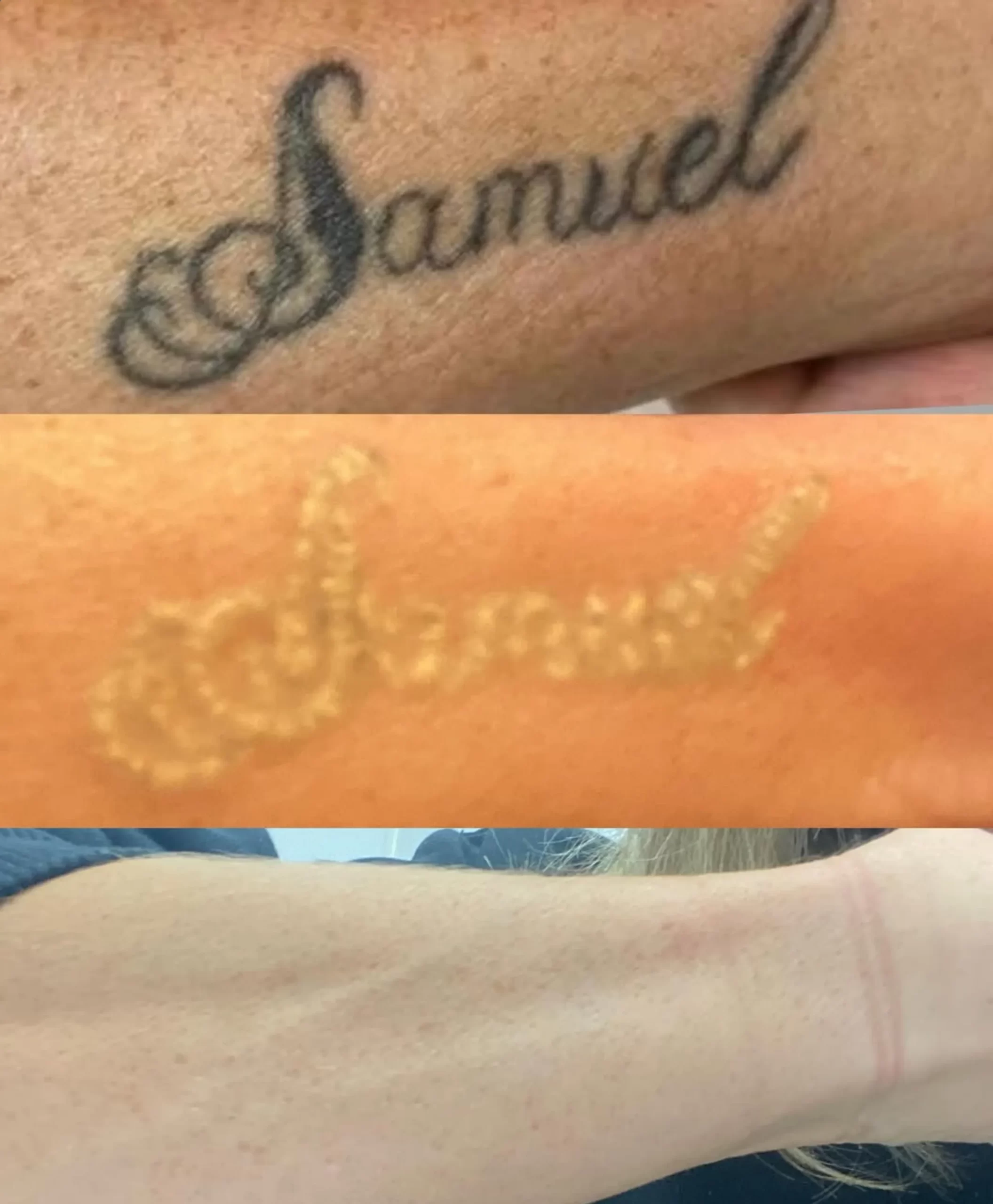 why tattoo removal doesn’t work sometimes