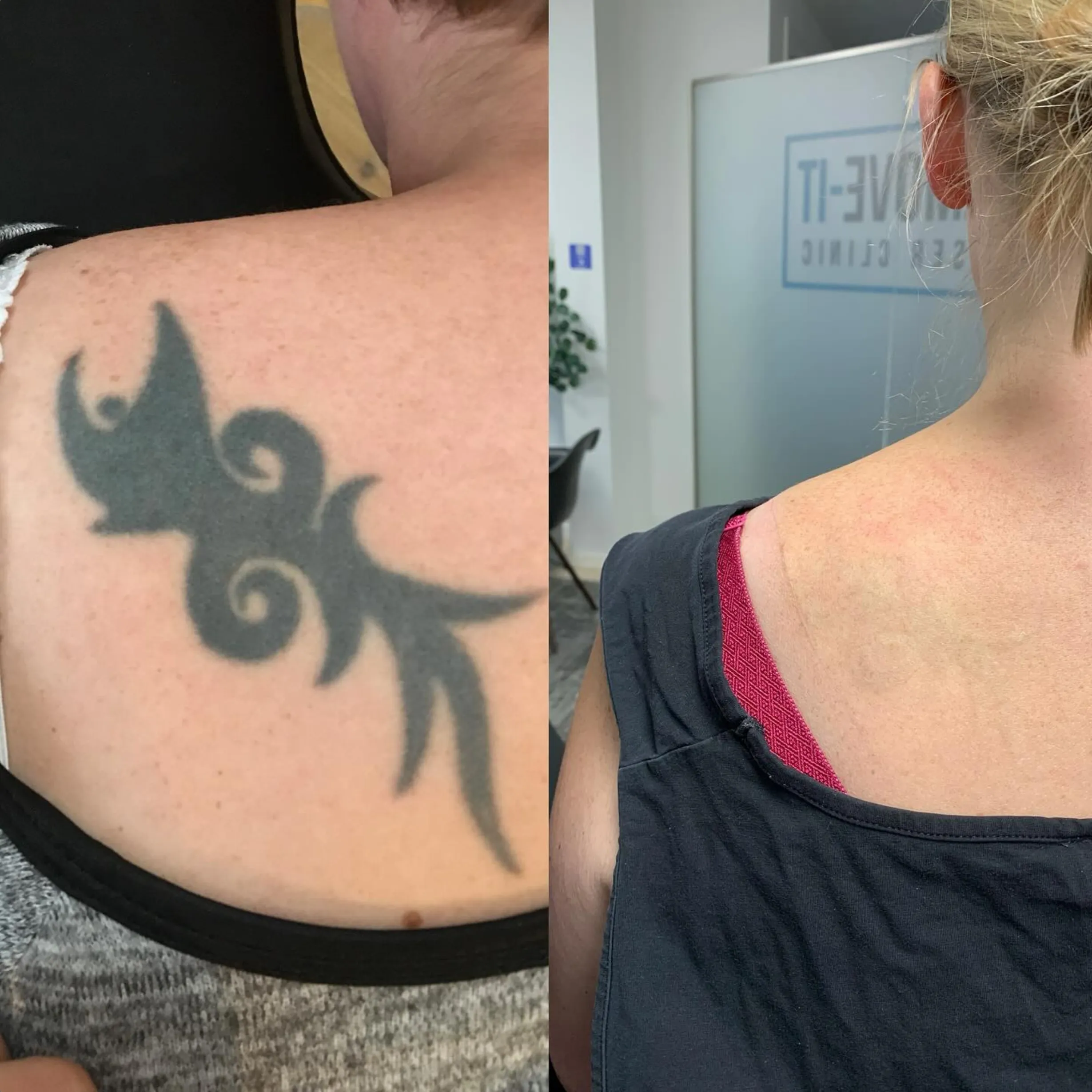tattoo removal success rate