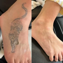 Does Tattoo Removal Work