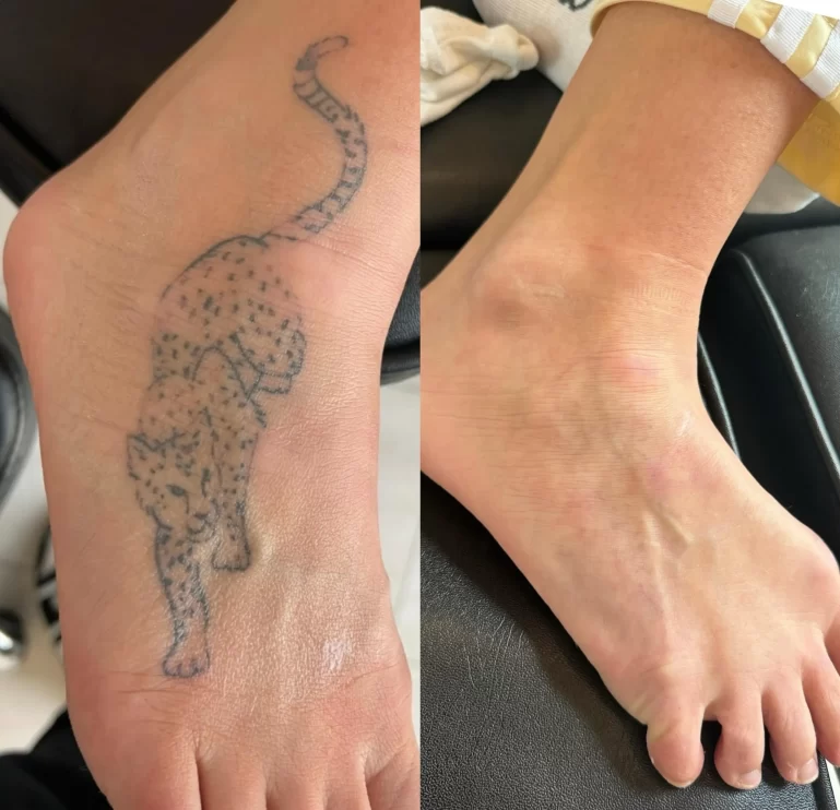 Does Tattoo Removal Work